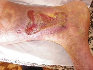 condition before starting treatment with Biostimul