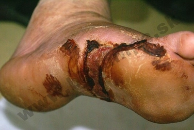 Diabetic foot 