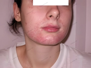 Condition before starting treatment with Biostimul